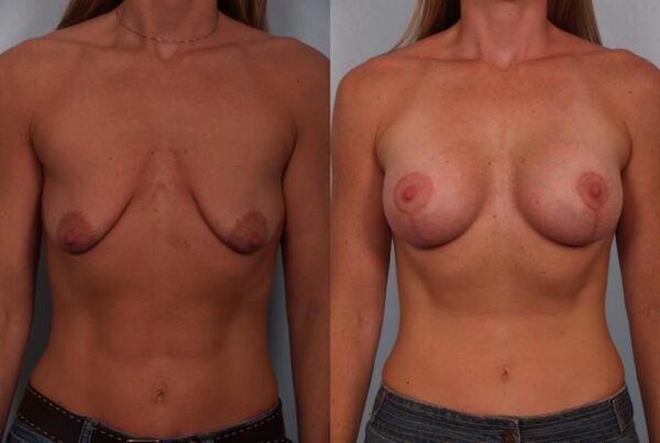 Breast Augmentation 153