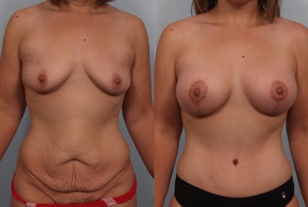 Breast Augmentation 154