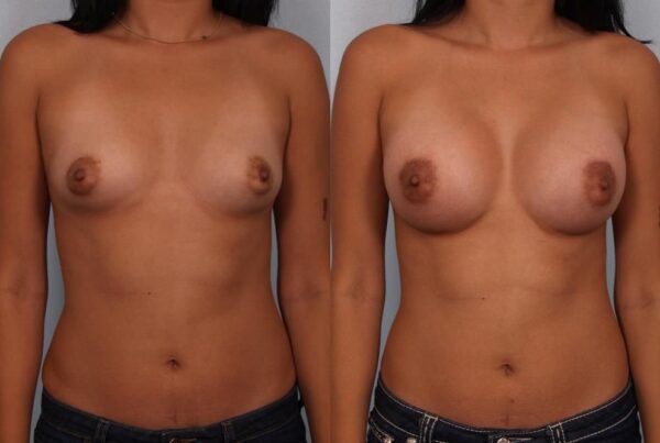 Breast Augmentation 155