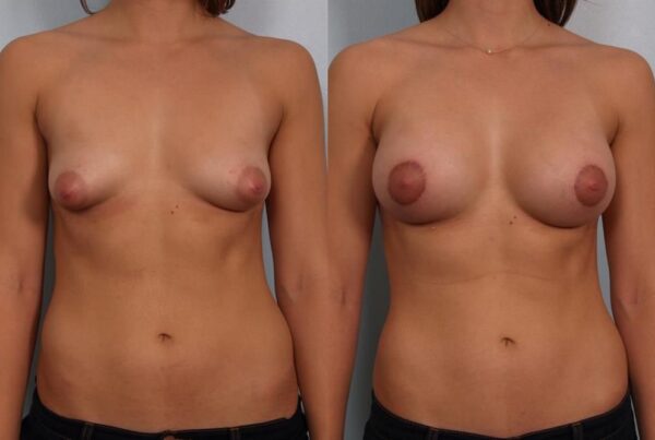 Breast Augmentation 156
