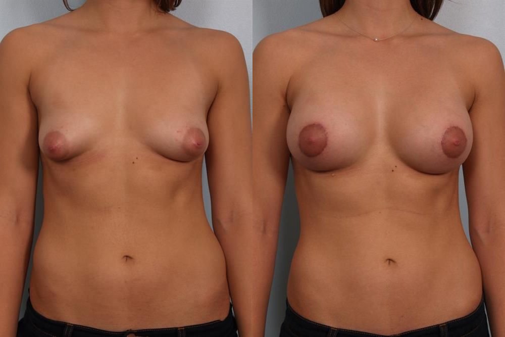 Breast Augmentation 156
