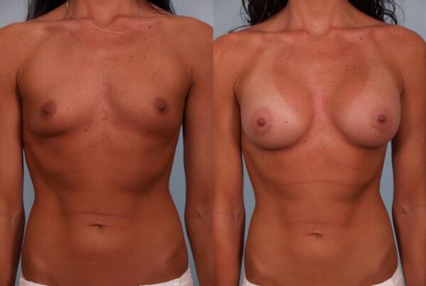 Breast Augmentation 157