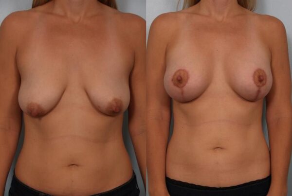 Breast Augmentation 158