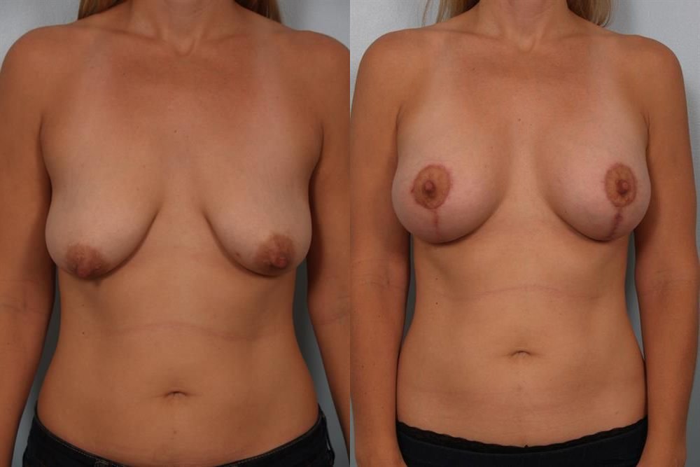 Breast Augmentation 158