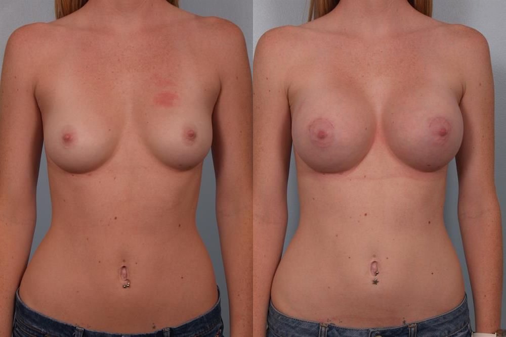 Breast Augmentation 159