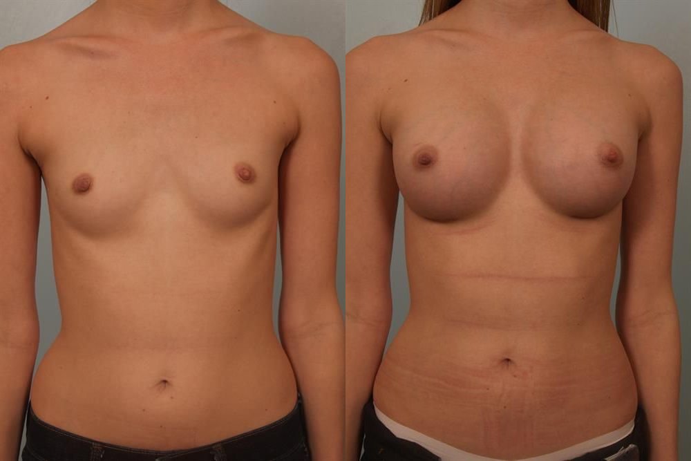 Breast Augmentation 16