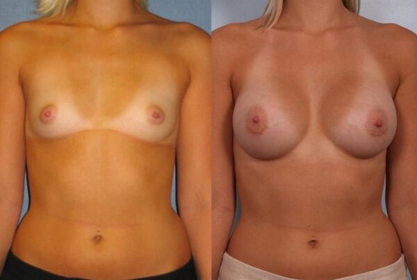 Breast Augmentation 160