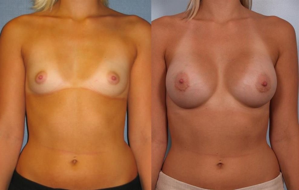 Breast Augmentation 160