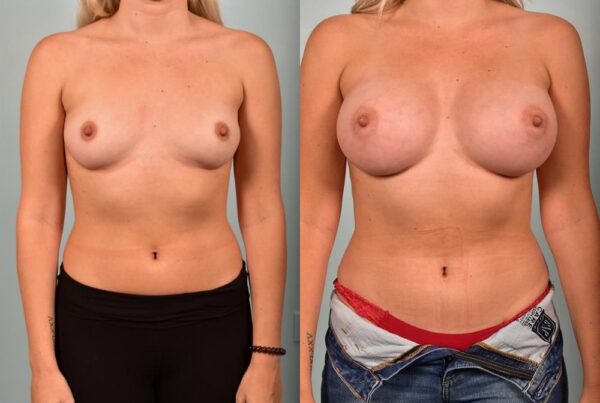 Breast Augmentation 161