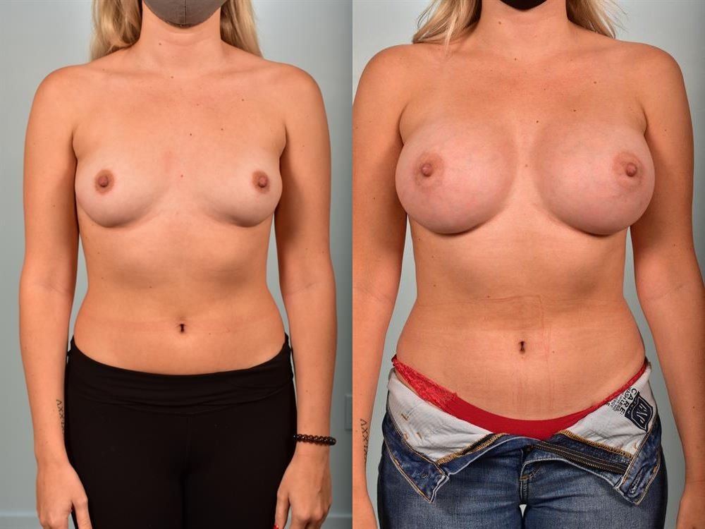 Breast Augmentation 161
