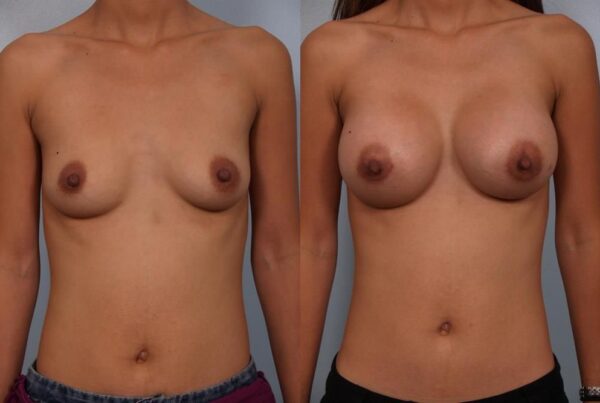 Breast Augmentation 163