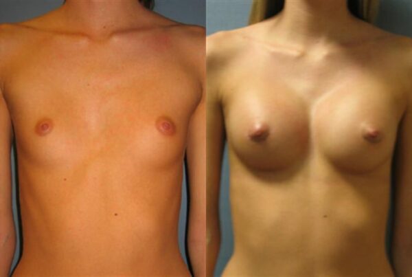 Breast Augmentation 164