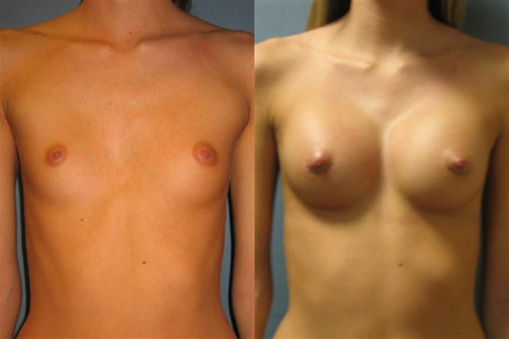Breast Augmentation 164