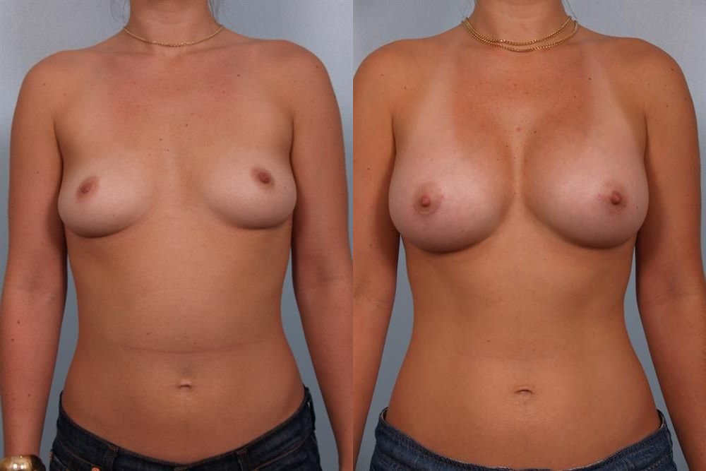Breast Augmentation 165