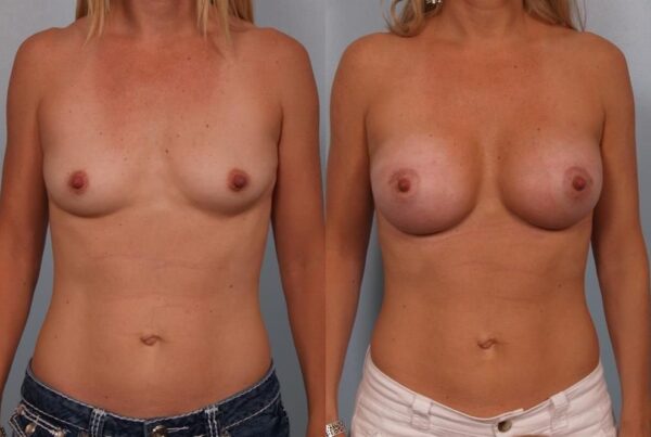 Breast Augmentation 166