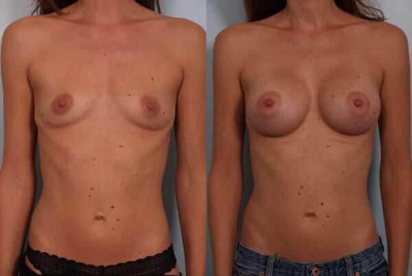 Breast Augmentation 167