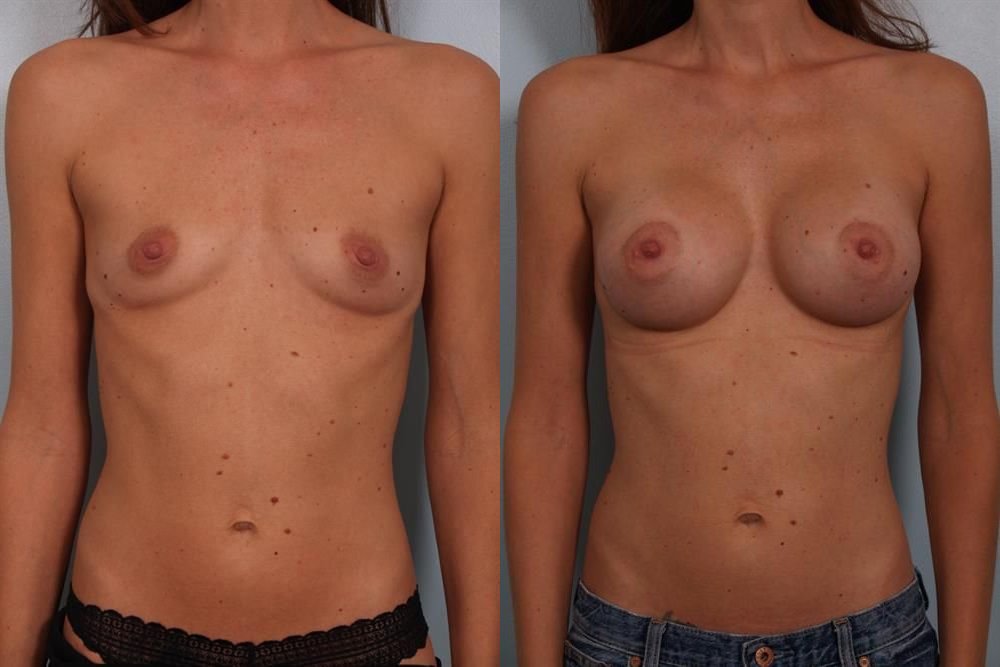 Breast Augmentation 167