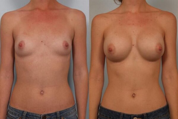 Breast Augmentation 168