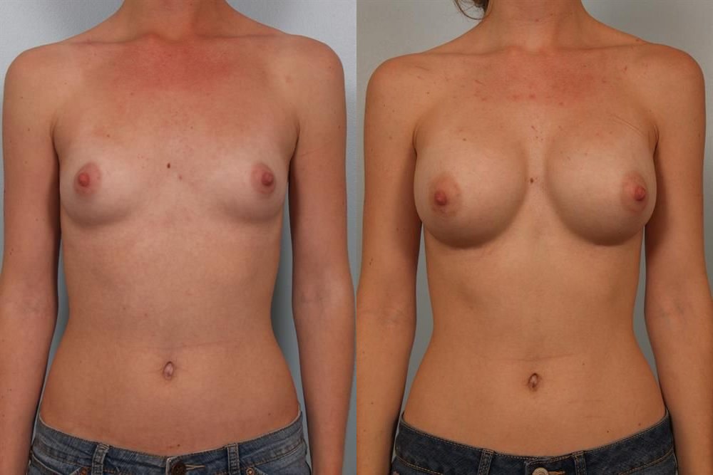 Breast Augmentation 168