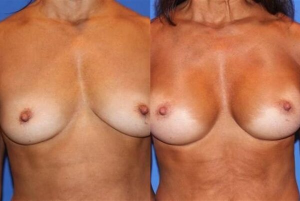 Breast Augmentation 169