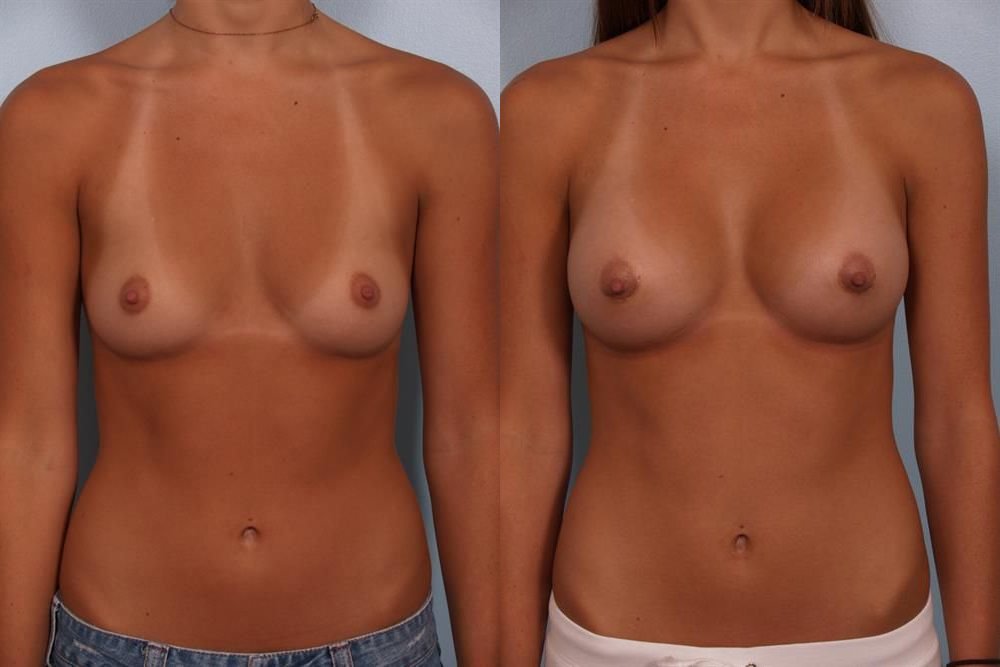Breast Augmentation 17