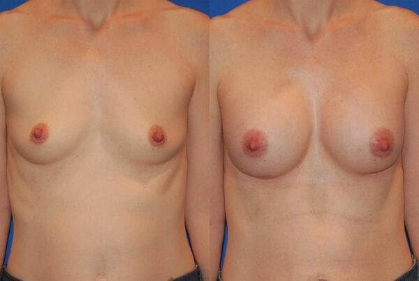 Breast Augmentation 170