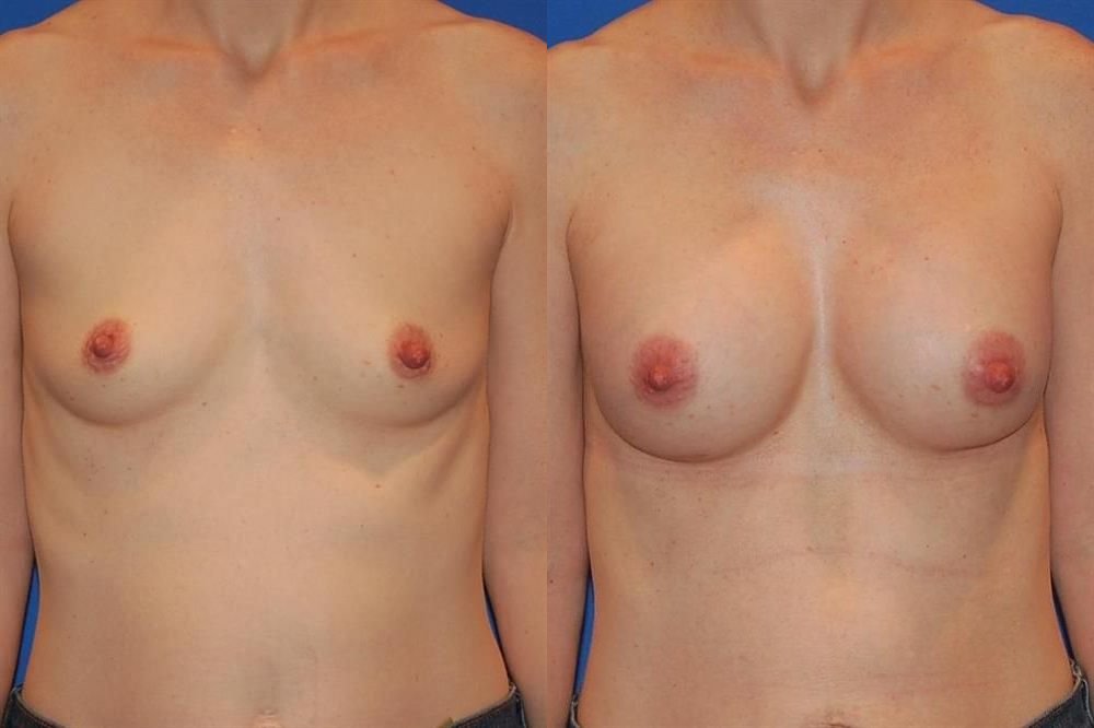 Breast Augmentation 170