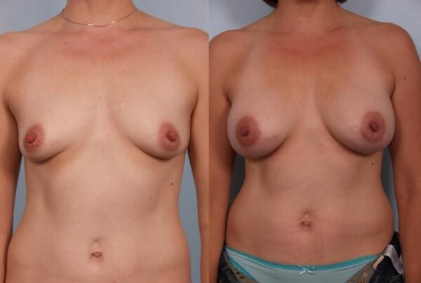 Breast Augmentation 171