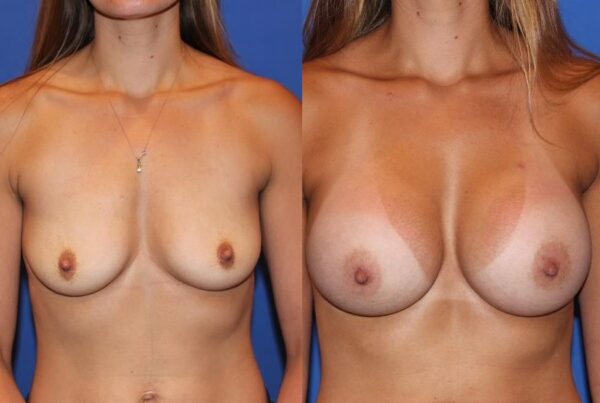 Breast Augmentation 172