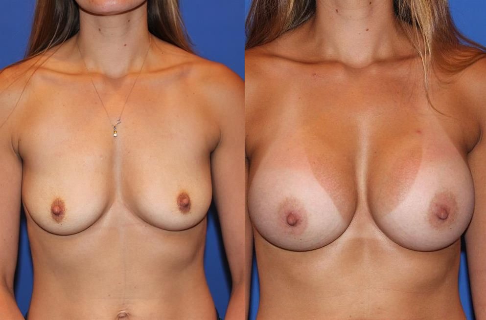 Breast Augmentation 172
