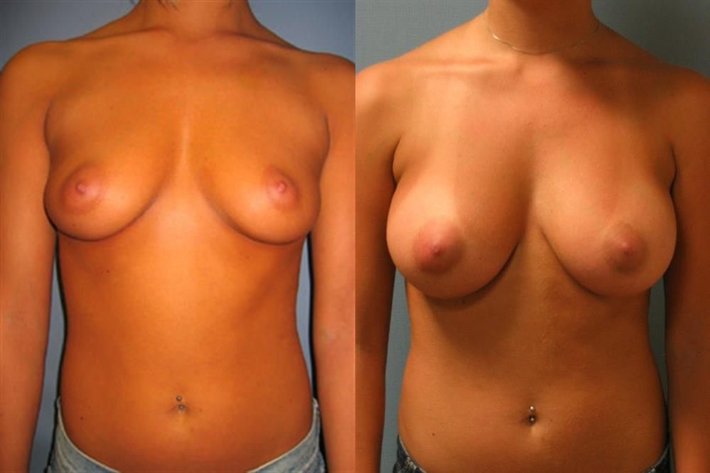 Breast Augmentation 173