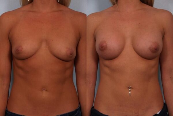 Breast Augmentation 174
