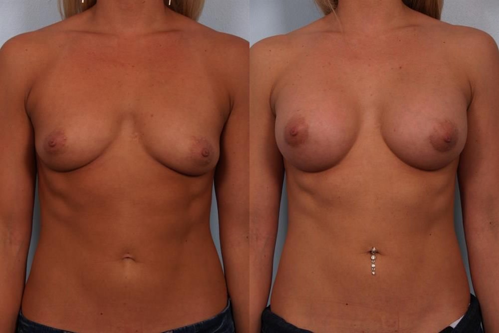 Breast Augmentation 174