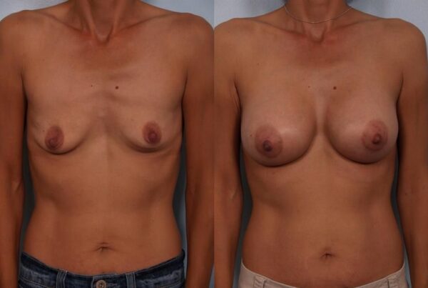 Breast Augmentation 175