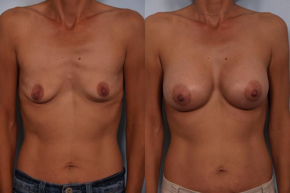 Breast Augmentation 175