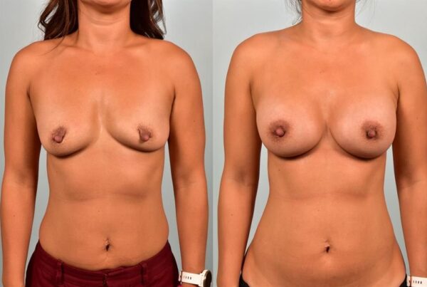 Breast Augmentation 176