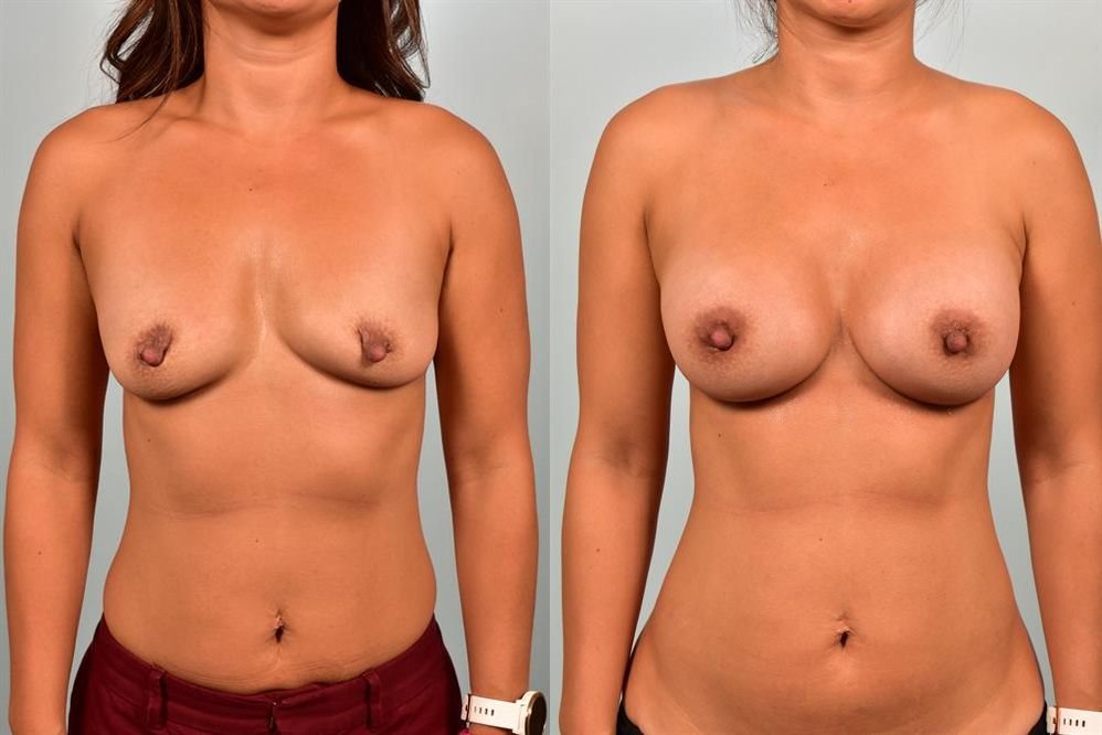 Breast Augmentation 176