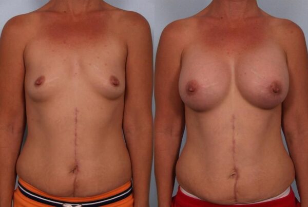 Breast Augmentation 177