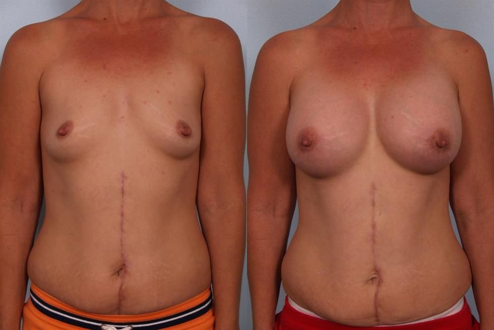 Breast Augmentation 177