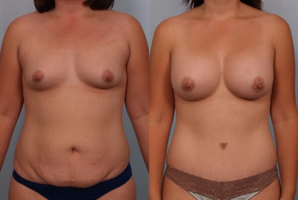 Breast Augmentation 178