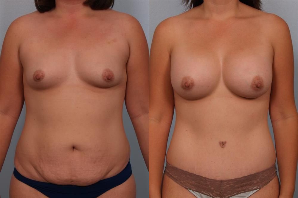 Breast Augmentation 178