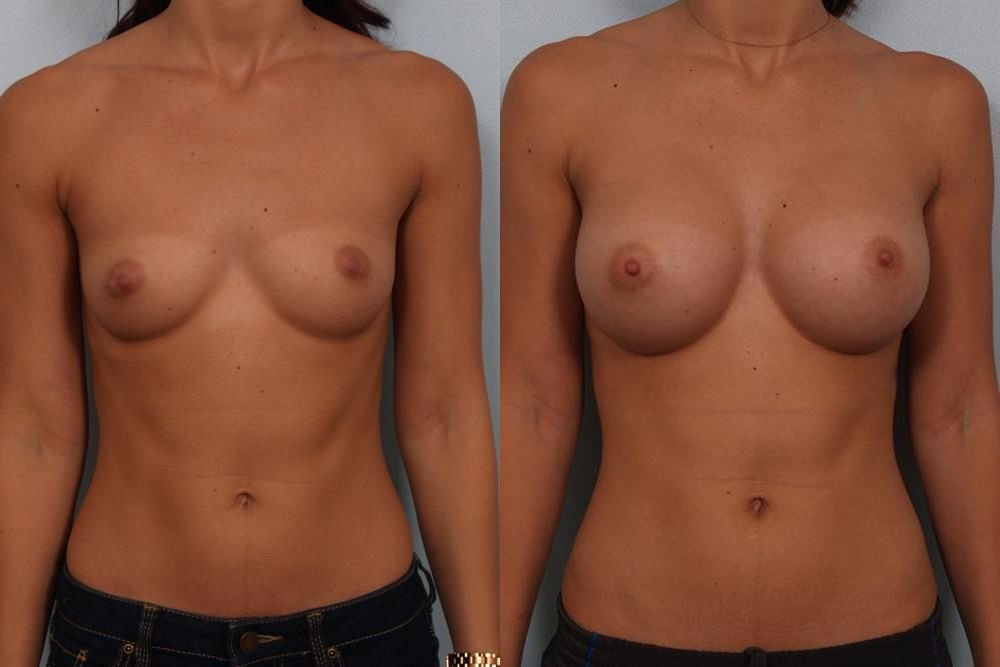 Breast Augmentation 18