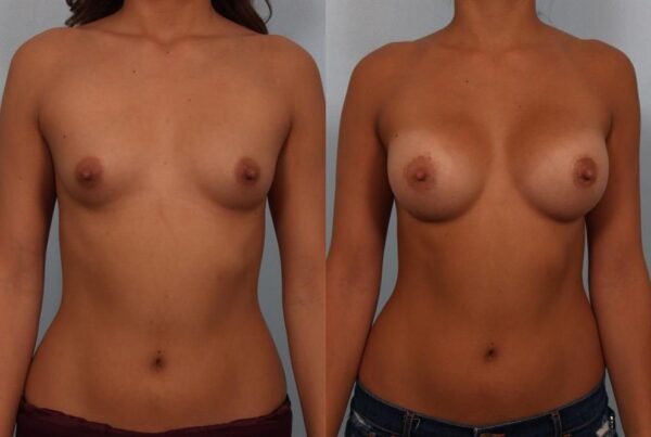 Breast Augmentation 180