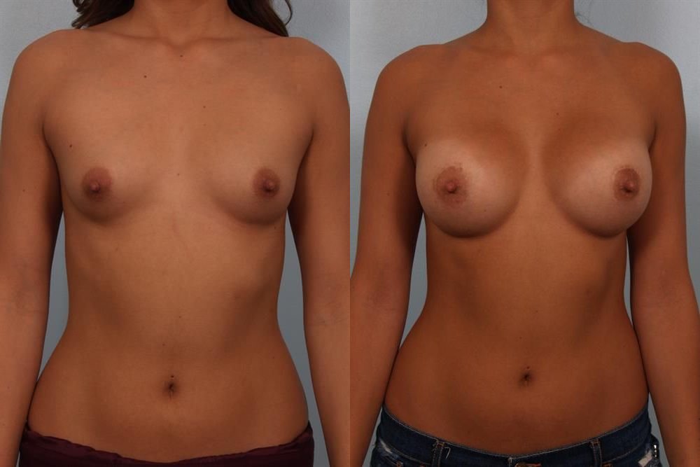 Breast Augmentation 180