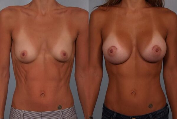 Breast Augmentation 182