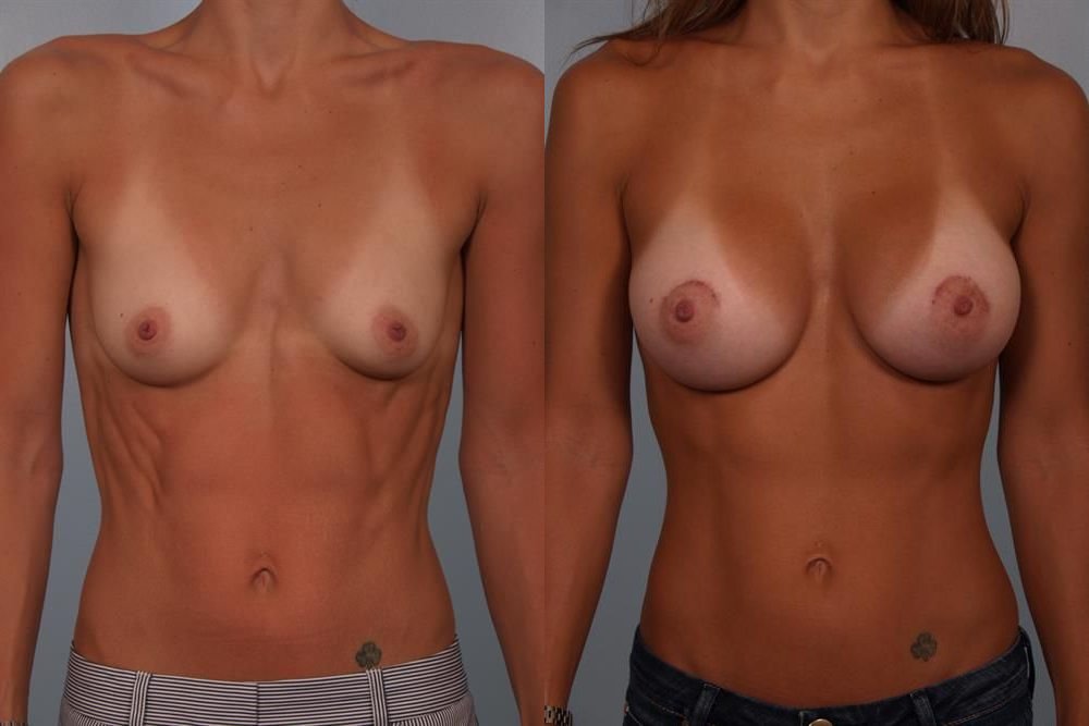 Breast Augmentation 182