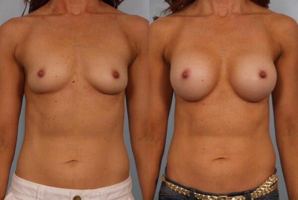 Breast Augmentation 183