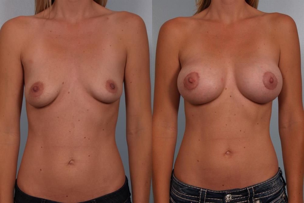 Breast Augmentation 184