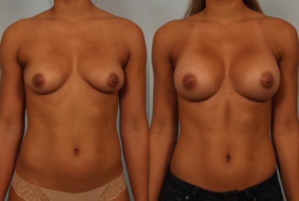 Breast Augmentation 185