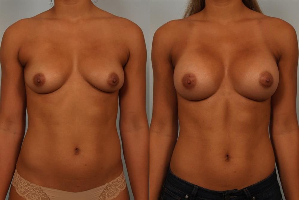Breast Augmentation 185